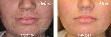 Acne & Acne Scarring - Before and After Case 3