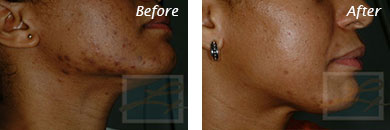 Acne & Acne Scarring - Before and After Case 14