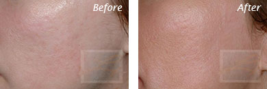 Acne & Acne Scarring - Before and After Case 20