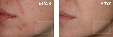 Acne & Acne Scarring - Before and After Case 27