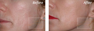 Acne & Acne Scarring - Before and After Case 28