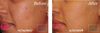 Acne & Acne Scarring - Before and After Case 40