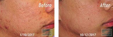 Acne Treatment Before and After Results in New Orleans, LA