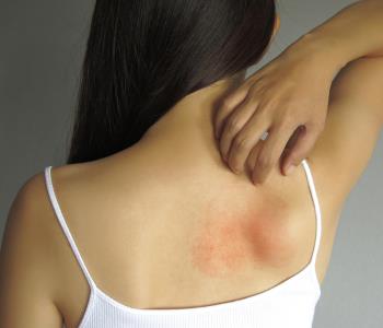 Best Eczema treatment from expert Dermatologist in New Orleans