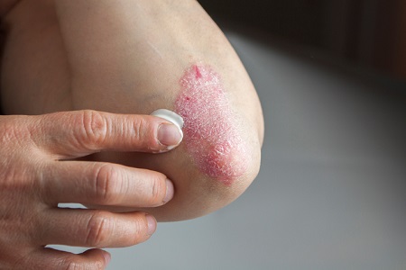 Treatment For Eczema from Dr. Mary Lupo, Lupo Center for Aesthetic and General Dermatology