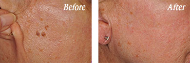 Can You Pick Off Seborrheic Keratosis Seborrheic Keratosis Removal New Orleans Skin Growth Treatments