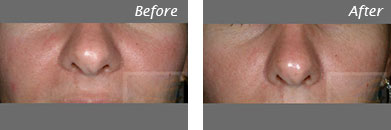 Sunken Cheeks - Before and After Case 4