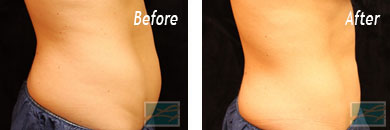 CoolSculpting for Fat Reduction Before & after gallery image