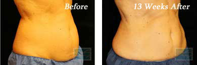 coolsculpting - Before and After Case 1