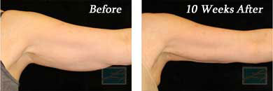coolsculpting - Before and After Case 2