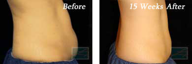 coolsculpting - Before and After Case 3