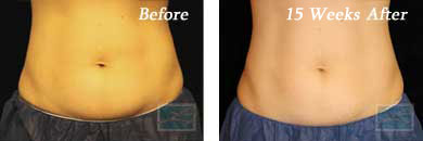 coolsculpting - Before and After Case 4
