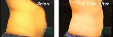 coolsculpting - Before and After Case 5