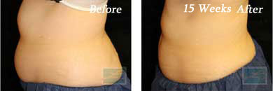 coolsculpting - Before and After Case 6
