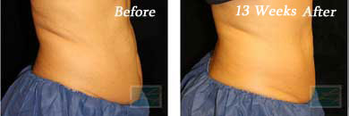 coolsculpting - Before and After Case 7