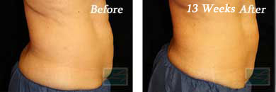 coolsculpting - Before and After Case 8