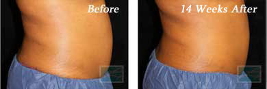 coolsculpting - Before and After Case 9