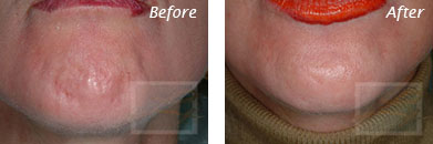 Fine Lines, Wrinkles & Folds - Before and After Case 21