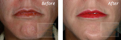 Fine Lines, Wrinkles & Folds - Before and After Case 23