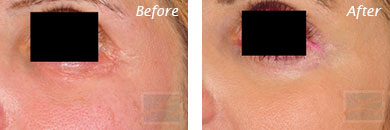 Eyes - Before and After Case 18