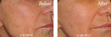Skin Tightening - Before and After Case 2