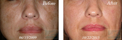 Texture, Pores & Discoloration - Before and After Case 48