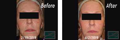 Asian Skins - Fraxel Before/After Image 07