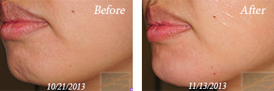juvederm - Before/After Image 03