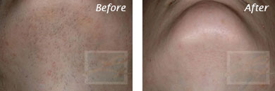 Laser Hair Removal - Before and After Case 12