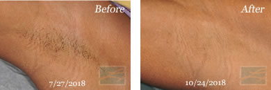 Laser Hair Removal - Before and After Case 2