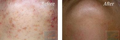 Laser Hair Removal - Before and After Case 10