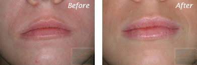Lips - Before and After Case 14