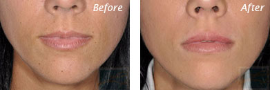 Lips - Before and After Case 16