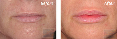 Lips - Before and After Case 17