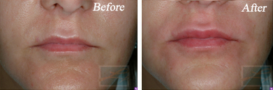 Lips - Before and After Case 31