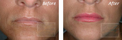Lips - Before and After Case 9