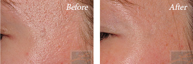MicroNeedling - Before and After New Orleans, LA