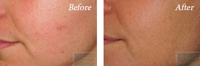 MicroNeedling - Before and After New Orleans, LA