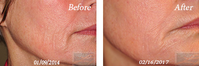 MicroNeedling - Before and After Case 1