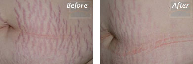 Neck, Abdomen & Chest - Before and After Case 35