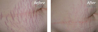 Neck, Abdomen & Chest - Before and After Case 36