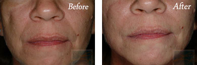 Facial Reshaping - Before and After Case 1