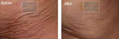 Skin Tightening - Before and After Case 1