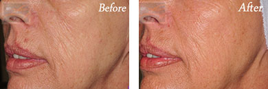 Fine Lines, Wrinkles & Folds - Before and After Case 37