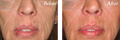 Fine Lines, Wrinkles & Folds - Before and After Case 39