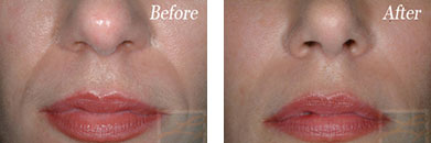 Facial Reshaping - Before and After Case 1
