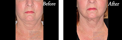 Skin Tightening - Before and After Case 10