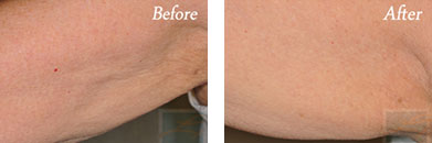 Skin Tightening - Before and After Case 22