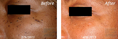 Spot Laser - Before and After Case 1