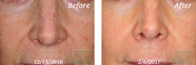 Texture, Pores & Discoloration - Before and After Case 7